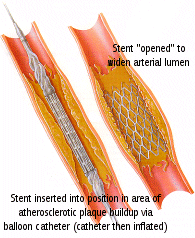 Arterial Stents