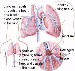 blood clot pulmonary lung embolism blockage artery